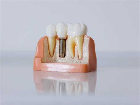 Dental Implant Success Rates What You Need To Know Dent Ally