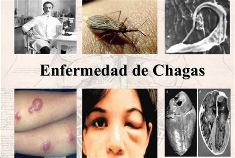 Enfermedad De Chagas