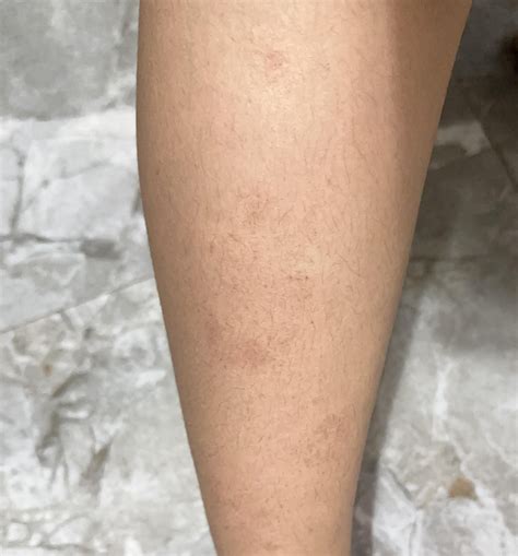 Spots on legs : r/AskDocs