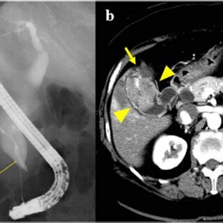 A Endoscopic Retrograde Cholangiopancreatography Showing PBM With A