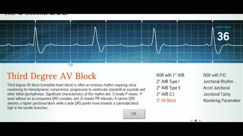 Easy Ekg Interpreting Rhythms Youtube