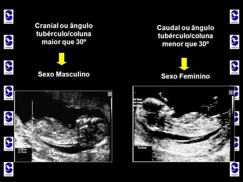 Como Saber O Tamanho Do Bebê Pelo Fêmur - Como Saber Tamanho Do Bebe Pelo Femur - NAZAEDU
