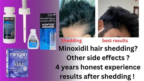 Minoxidil Shedding Phase And Results After Shedding Honest Experience