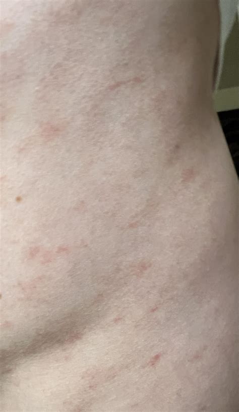 Rash Thats Been Spreading The Last Few Weeks Trying To Figure Out