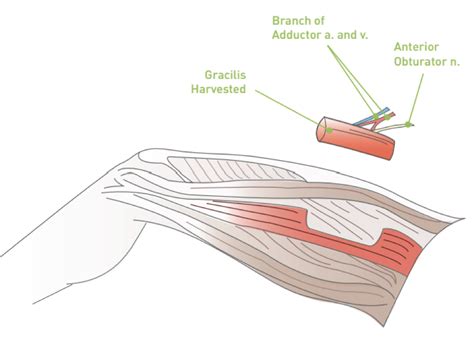 Gracilis Muscle Flap - Free Gracilis Muscle Transfer For Facial Paralysis