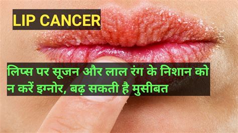 इन संकेतों को ना करे नजरअंदाज हो सकते है Lip Cancer के संकेत Lip