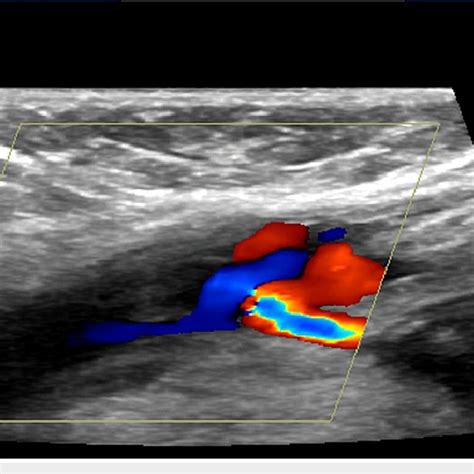 Doppler of the right great saphenous vein. Occlusive deep venous... | Download Scientific Diagram