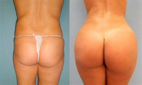 Lipofilling Glutei Turchia Costo Procedura Miglioreclinica