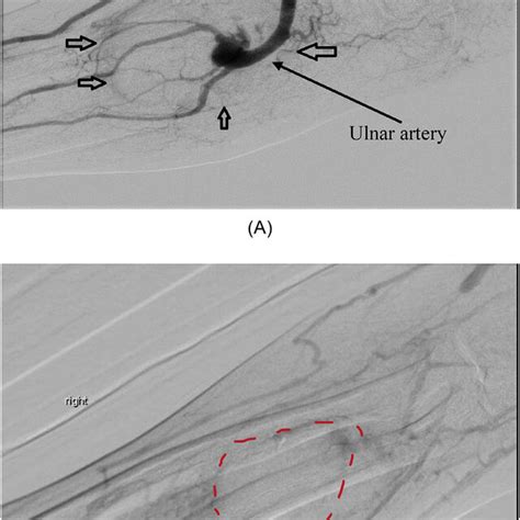 A Angiogram Arterial Phase Arrow Indicating Probable True Aneurysm