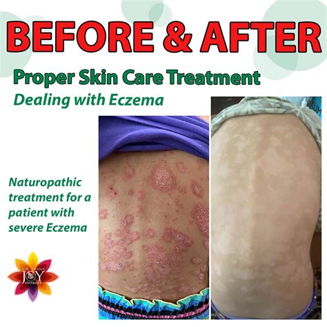 Skin Care and Severe Eczema - Dr. Diana Joy Ostroff