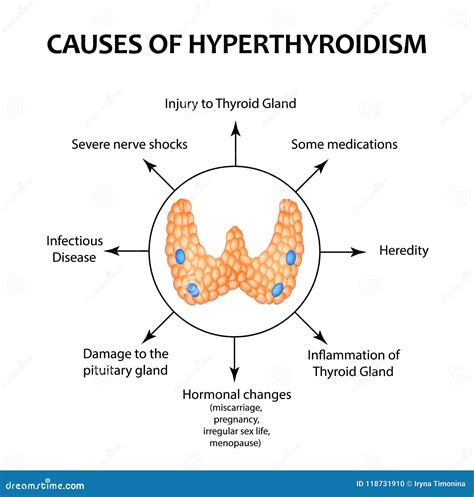 The Causes of Hyperthyroidism of the Thyroid Gland. Infographics. Vector Illustration on ...