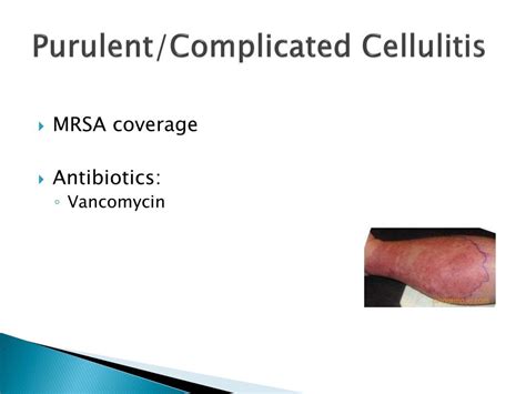 PPT Inpatient Skin And Soft Tissue Infections PowerPoint Presentation