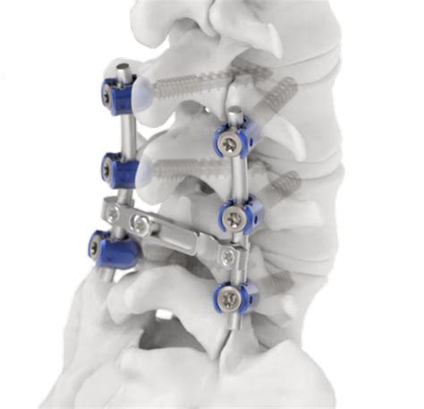 Parafuso Pedicular Cervical Jeil Medical Corporation Poliaxial Em