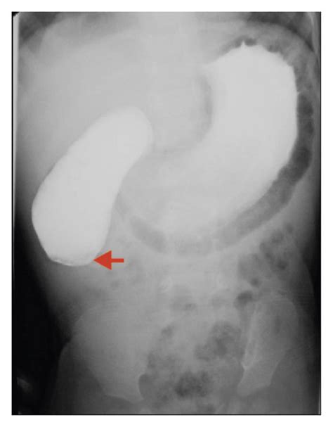 Upper Gastrointestinal Contrast Study Revealing Complete Obstruction At