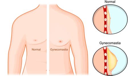 Gynecomastia Causes Symptoms And Treatment