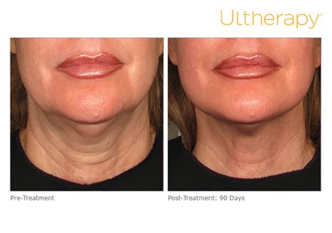 Non Surgical Facelift With Ultherapy MI Skin Dermatology