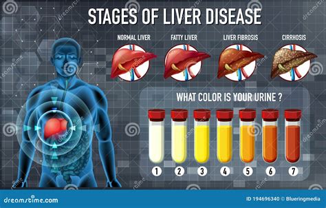 Stages of liver disease stock vector. Illustration of details - 194696340