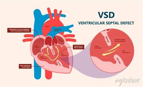 Cath Lab Atrial Septal Defect Tetralogy Of Fallot Patent Foramen