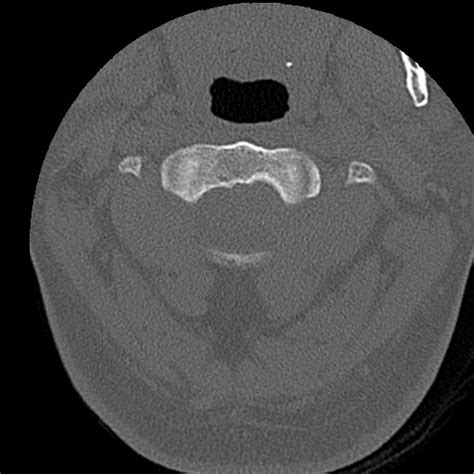 Cervical Spinal Neurofibroma In A Patient With Nf Radiopaedia