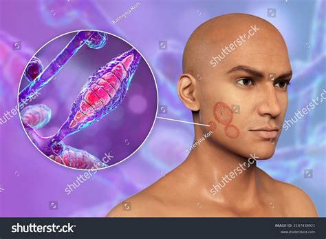 Microsporum Canis Fungal Infection On Mans Stock Illustration ...