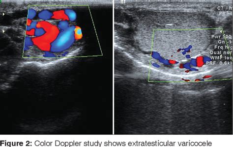 Figure 2 From Intratesticular Varicocele Semantic Scholar