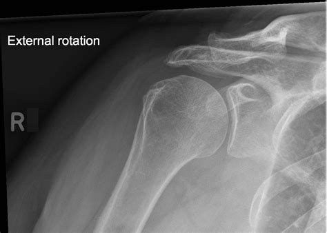 Right Shoulder X Ray Views At Anja Flores Blog