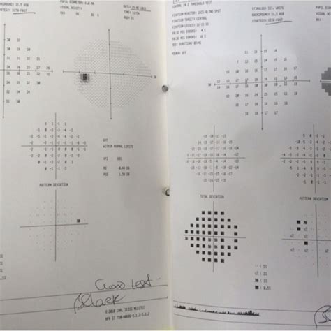 Visual fields at the first appointment in the glaucoma clinic showing ...