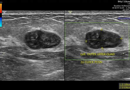 Fibroadenoma Breast Radiology Reference Article Radiopaedia Org