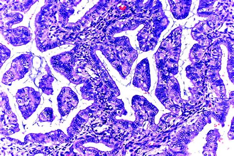 Endometrial Metaplasias And Reactive Changes A Spectrum Of Altered