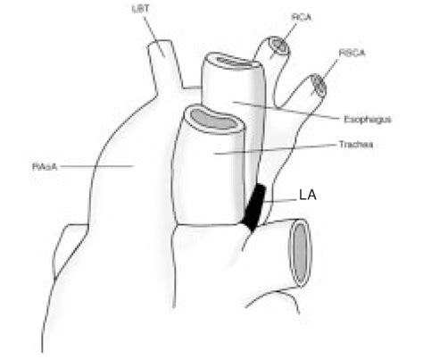 Left lateral view shows ligamentum arteriosum, which completes vascular ...