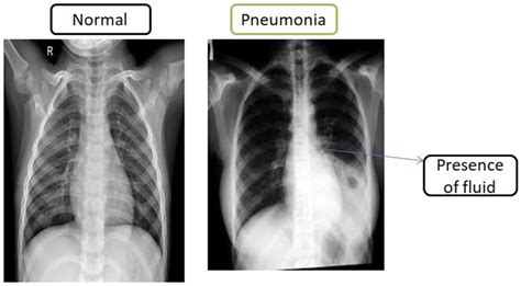 Difference in Chest X Ray Images in Normal and Pneumonia | Download Scientific Diagram