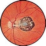 Eye Infections usually are a red burning sensitive eye.