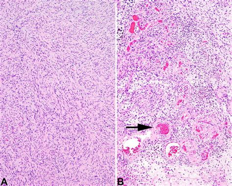 A Cellular Schwannoma Consisting Of Intersecting Fascicles Of Spindle