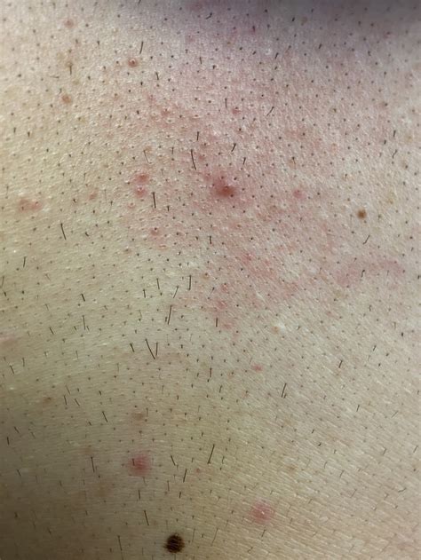 Is it normal for some chest hair not to shed two weeks after my first laser session? : r/HairRemoval