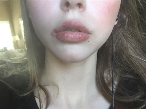 Accutane Side Effects Lips