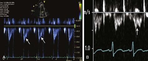 Echocardiographic Evaluation Of The Patient With Pulmonary Hypertension Thoracic Key