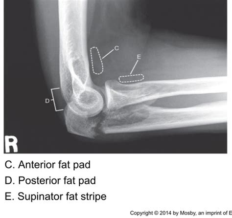 Upper Extremity Anatomy Flashcards Quizlet