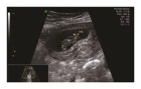 US image of intrauterine pregnancy. | Download Scientific Diagram