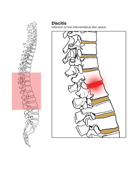 Diskitis Statpearls Ncbi Bookshelf