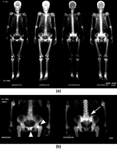 Various Musculoskeletal Manifestations Of Chronic Renal Insufficiency Clinical Radiology