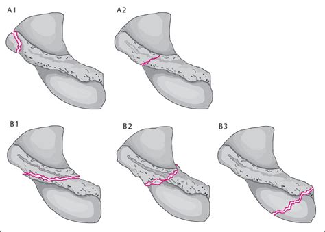 Scaphoid Fracture Classification