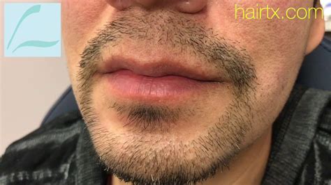 Dallas Beardgoateemoustache Hair Transplant Hd Close Up Result Youtube