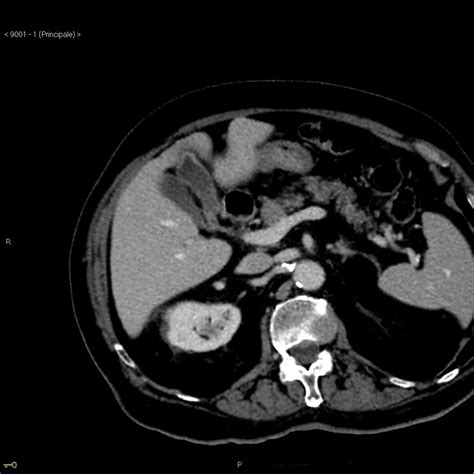 Gallbladder Duplication Image