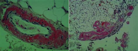 The Lesion Mainly Comprised Amyloid Deposition Showing Congo Red Stain