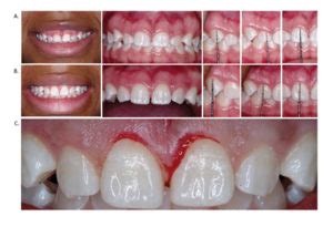 Treating the “Gummy Smile” with Aesthetic Crown Lengthening