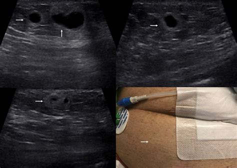 Abdominal Hematoma Ultrasound