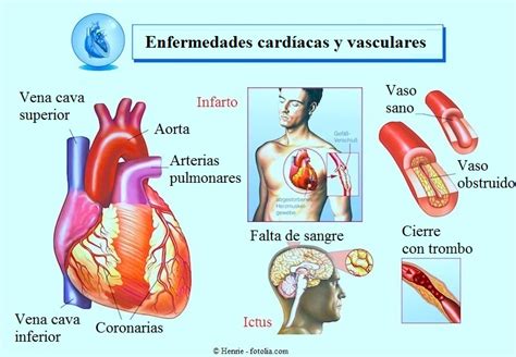 Cardiopatía Isquémica Causas Síntomas Y Complicaciones