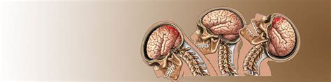 Traumatismo Craneoencef Lico Grave Fisiopatologia Clasificacion Y The