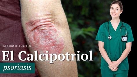 El Calcipotriol Psoriasis 👨‍⚕️ Consultorio Médico Youtube