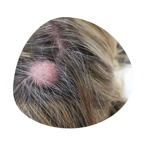 Cyst Removal - LipomaCyst.com | Lipoma & Cyst Specialists